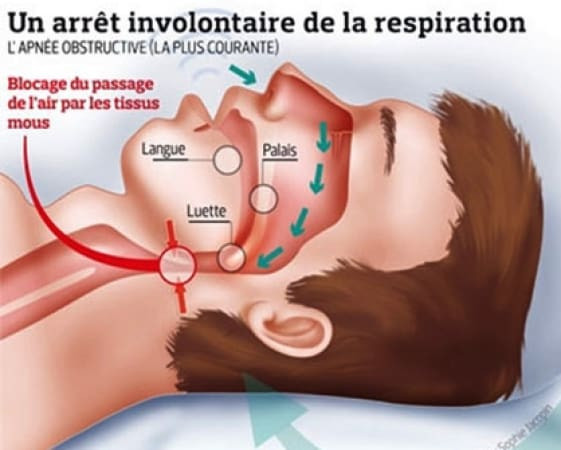 L'appel des experts: Intégrer l'apnée du sommeil obstructive dans les critères médicaux de conduite professionnelle