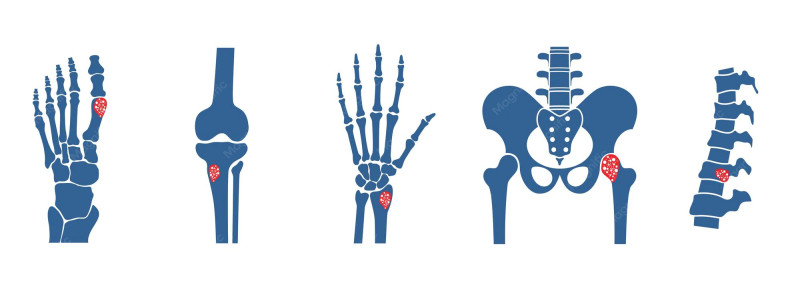 Les dernières avancées scientifiques sur les maladies des articulations et des os
